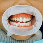 apple cider vinegar dental health concerns